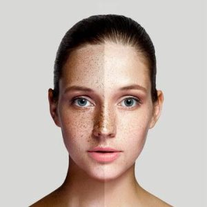 علل ایجاد و راه‌های پیشگیری از لک‌ پوستی
